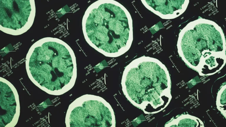 Alzheimer unutkanlıkla başlamıyor