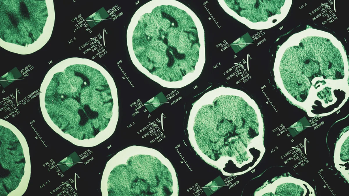 Alzheimer unutkanlıkla başlamıyor
